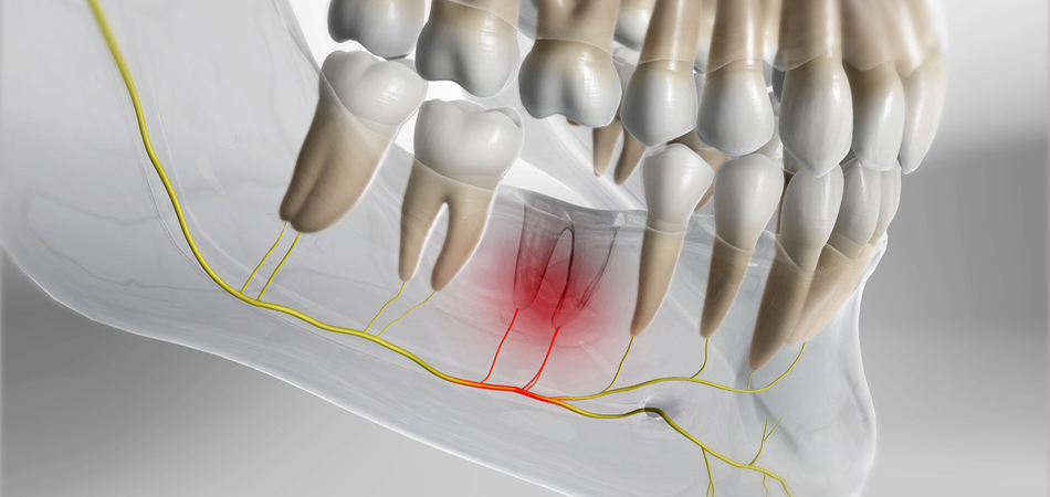 dry tooth cavity; Symptoms, causes, quick treatment and prevention methods