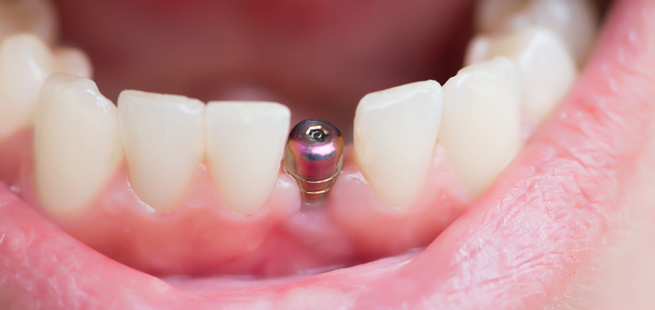 0 to 100 dental implant steps: a complete review of the implant process