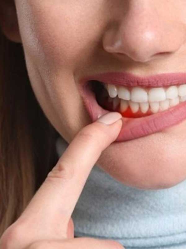 Gum lift, smile design, gum beauty surgery, beautiful smile, dentistry, beauty dentistry, Viva