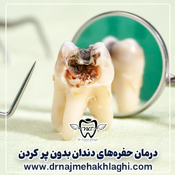 Is it possible to treat tooth decay without filling? - Dr. Najmeh Ethali