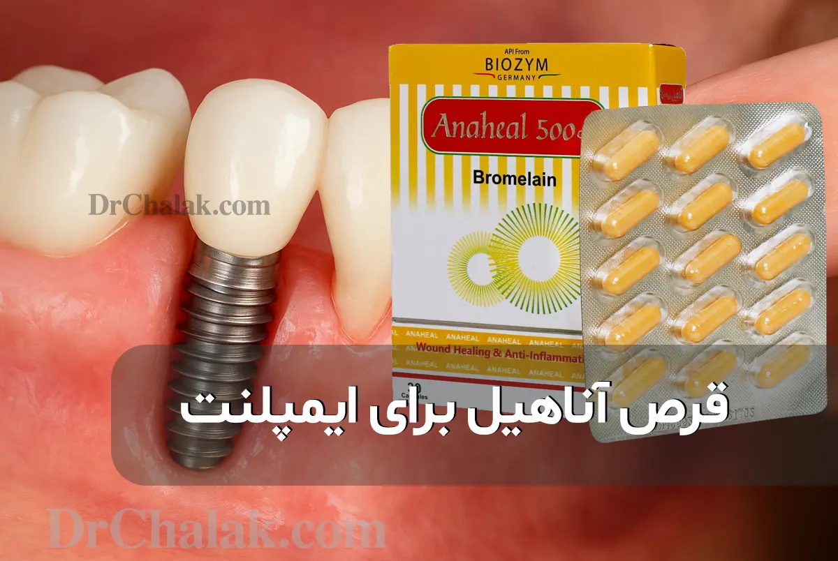 قرص آناهیل برای ایمپلنت کاهش التهاب و تسریع بهبودی پس از جراحی دندان