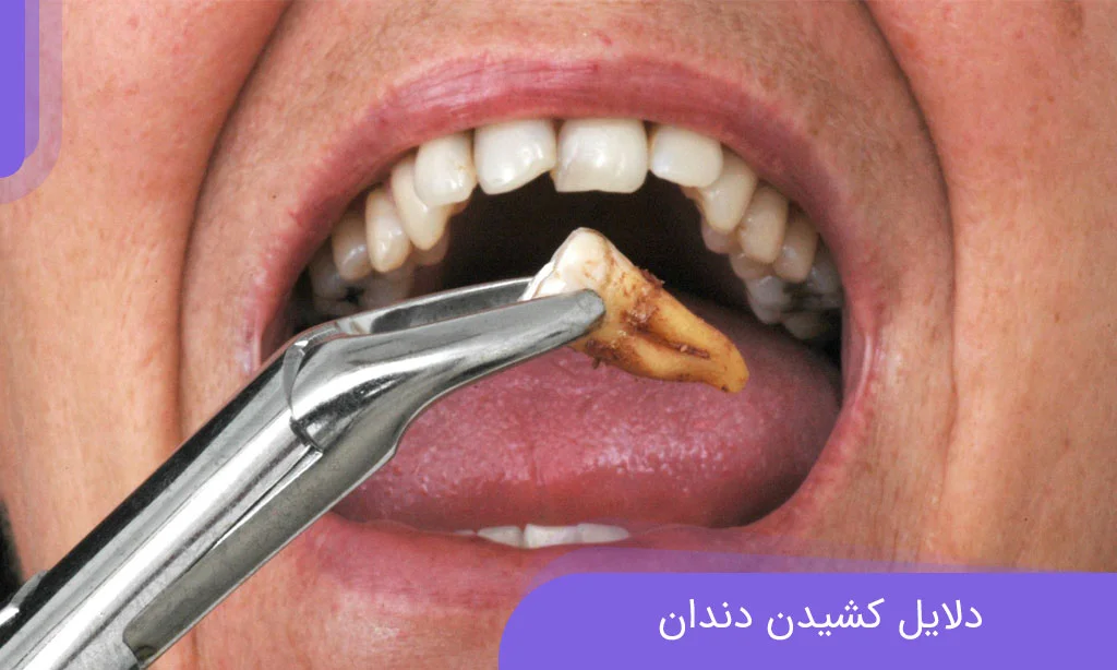 8 reasons that cause tooth extraction! Dr. Khadavi