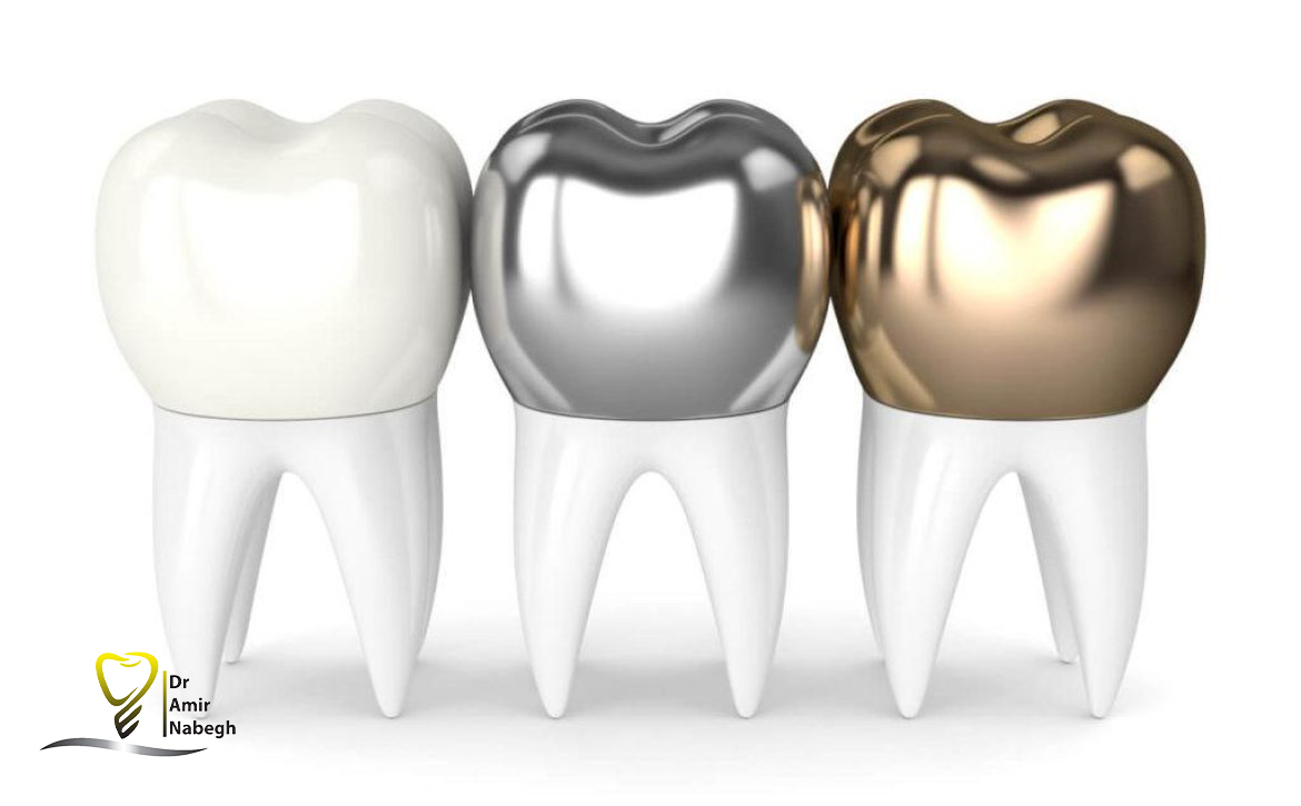 همه چیز در مورد روکش دندان