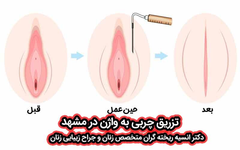 تزریق چربی واژن در مشهد; بازگرداندن جوانی و حجم طبیعی بر اساس تجربه و طب بی خطر