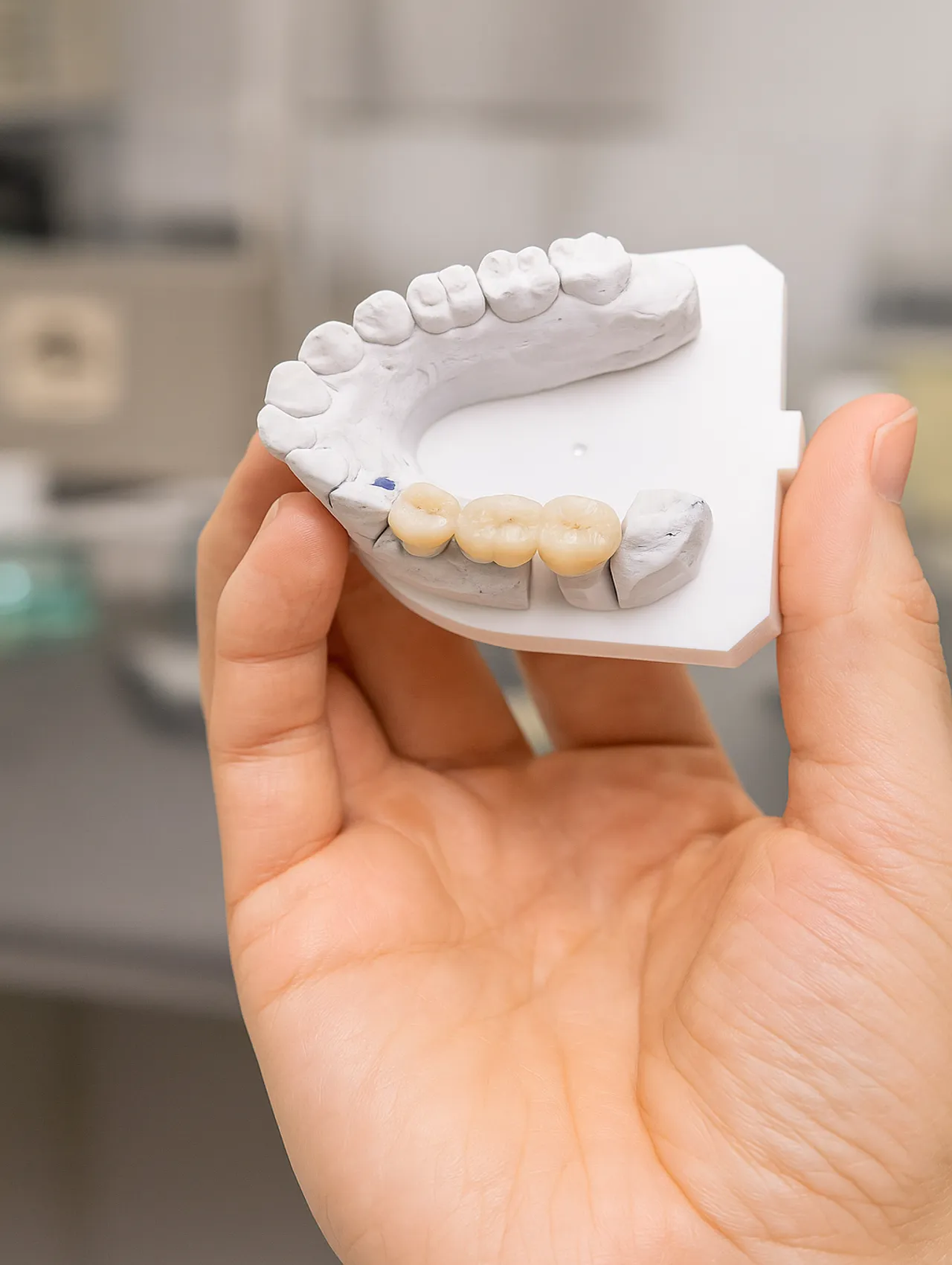 Dental bridge or dental bridge: a permanent solution to replace missing teeth