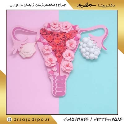 متلازمة المبيض المتعدد الكيسات: مراجعة شاملة