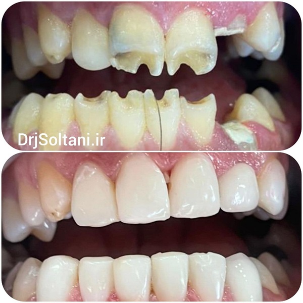 لمینت کامپوزیت دکتر جمال سلطانی جراح دندانپزشک و متخصص ایمپلنت در تبریز