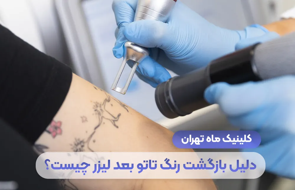 ما هو سبب عودة لون الوشم بعد الليزر؟ - عيادة طهران ماه