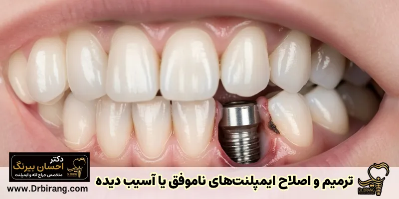 Repair of broken and failed dental implant | Implant repair and restoration methods in Tehran - Dr. Ehsan Birang