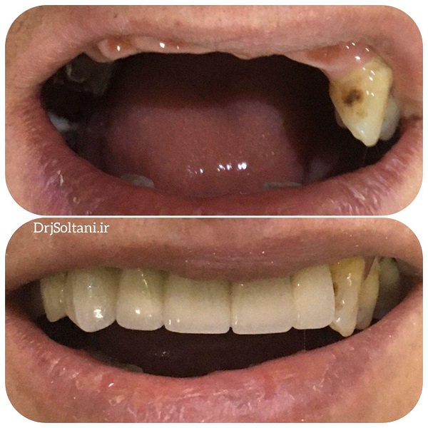 کاشت ایمپلنت در تبریز دکتر جمال سلطانی جراح دندانپزشک و متخصص ایمپلنت در تبریز