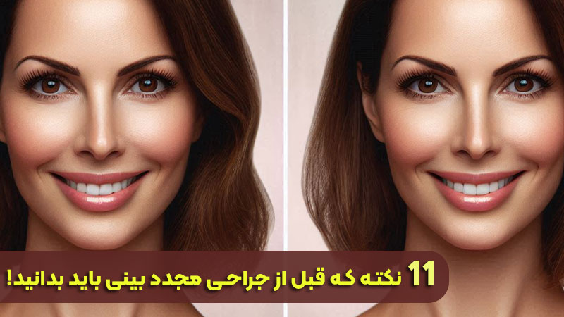 11 أشياء يجب أن تعرفها قبل جراحة الأنف