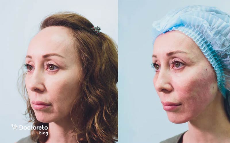 Investigating methods of treating facial swelling after a thread lift