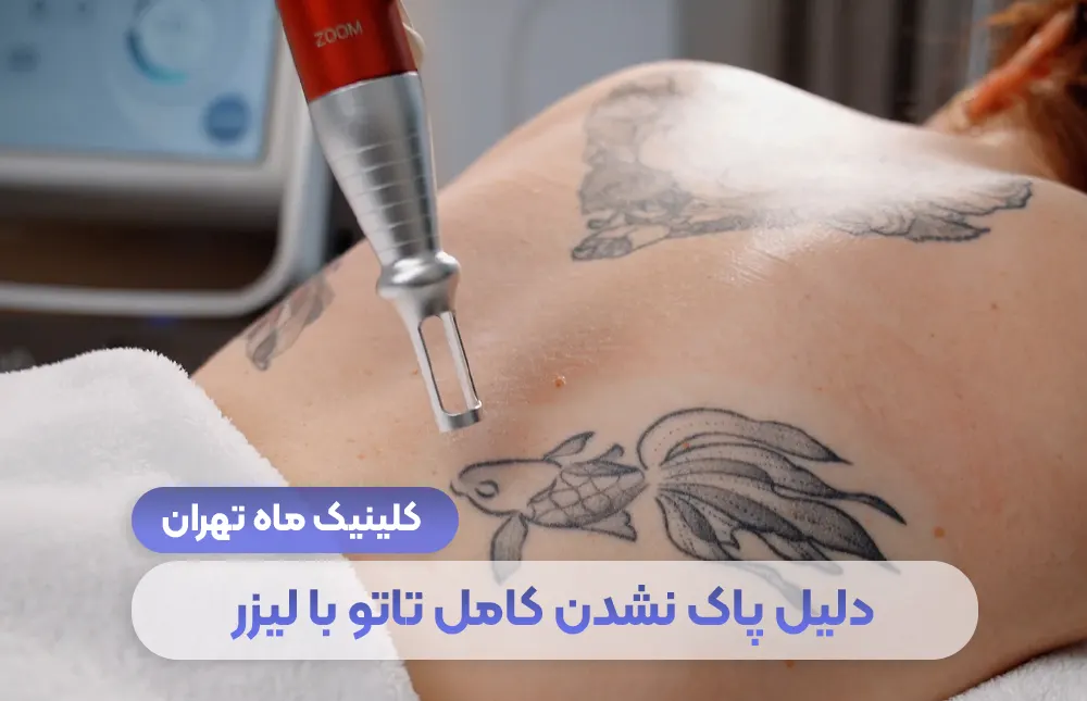 What is the reason for not completely erasing the tattoo with laser? Solution for permanent tattoo removal - Mah Clinic, Tehran