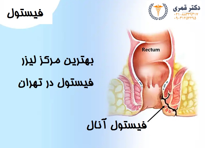 بهترین مرکز لیزر فیستول در تهران