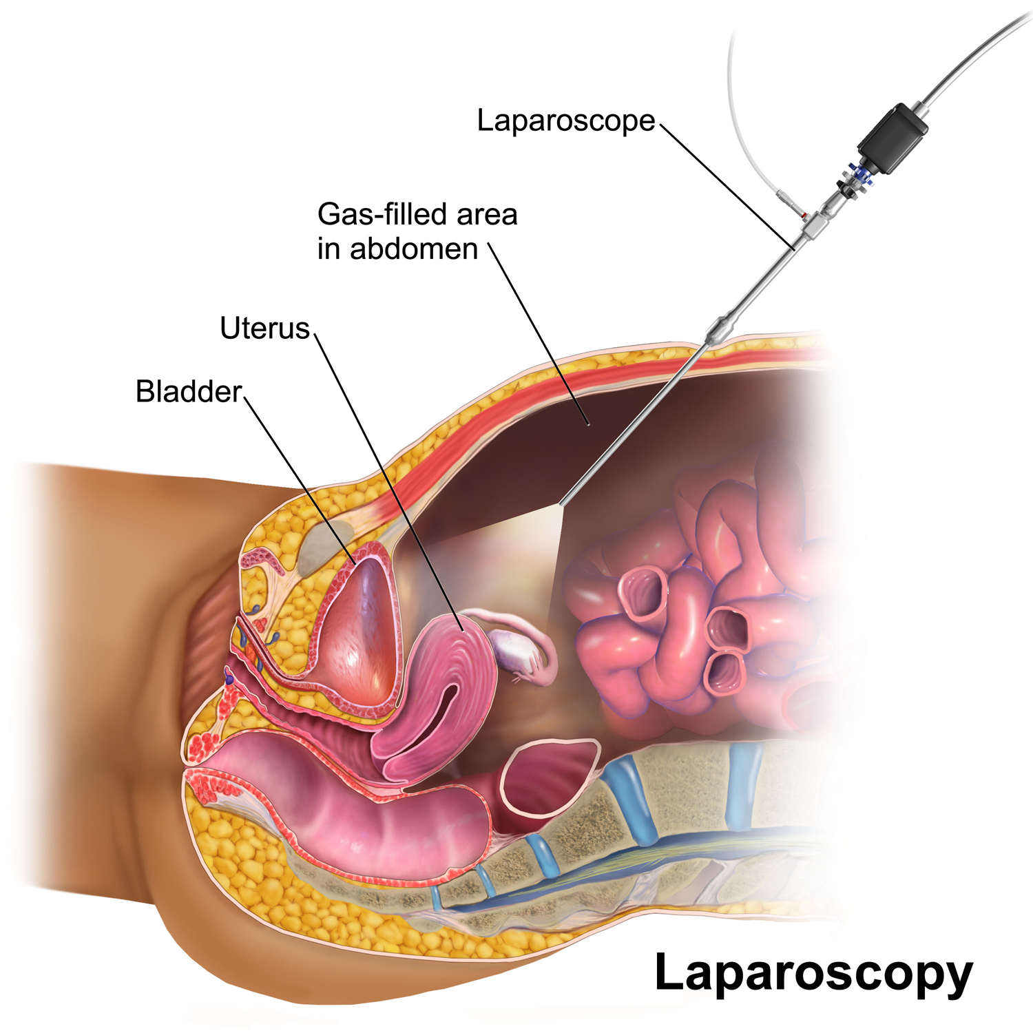 Laparoscopy - Hera Medical Group