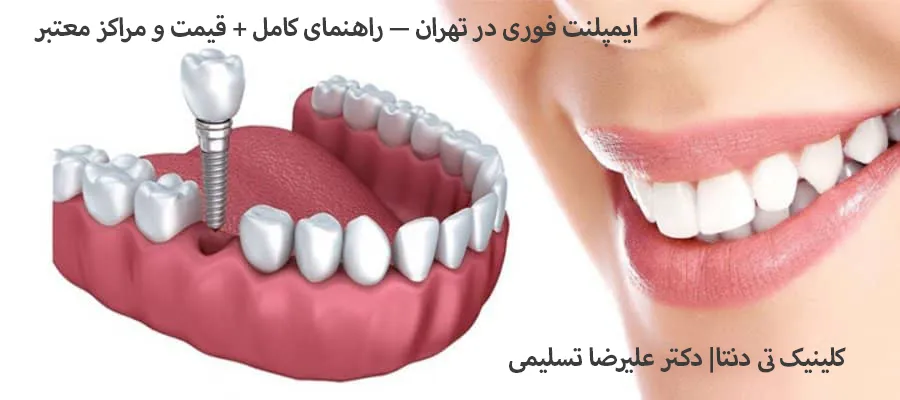 ایمپلنت فوری در تهران قیمت 1404 + بهترین متخصصین