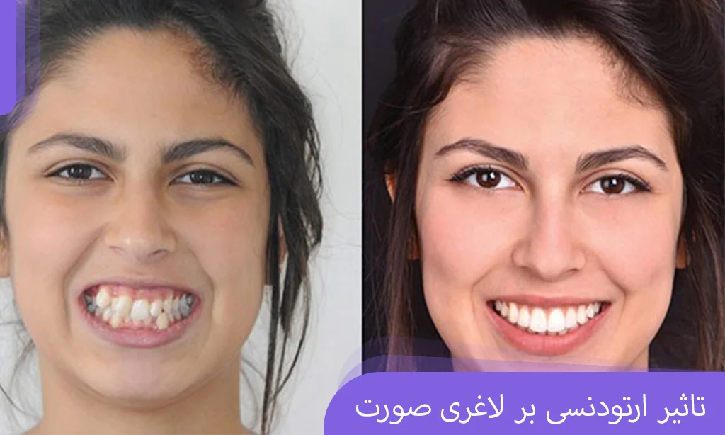 The effect of orthodontics on facial thinness Does orthodontics make the face thinner? Dr. Khadavi
