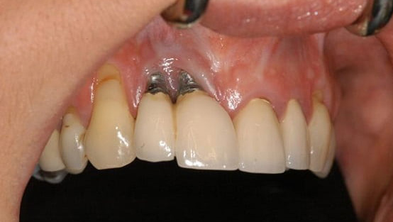 The cause of gingivitis after implant + treatment Amytis