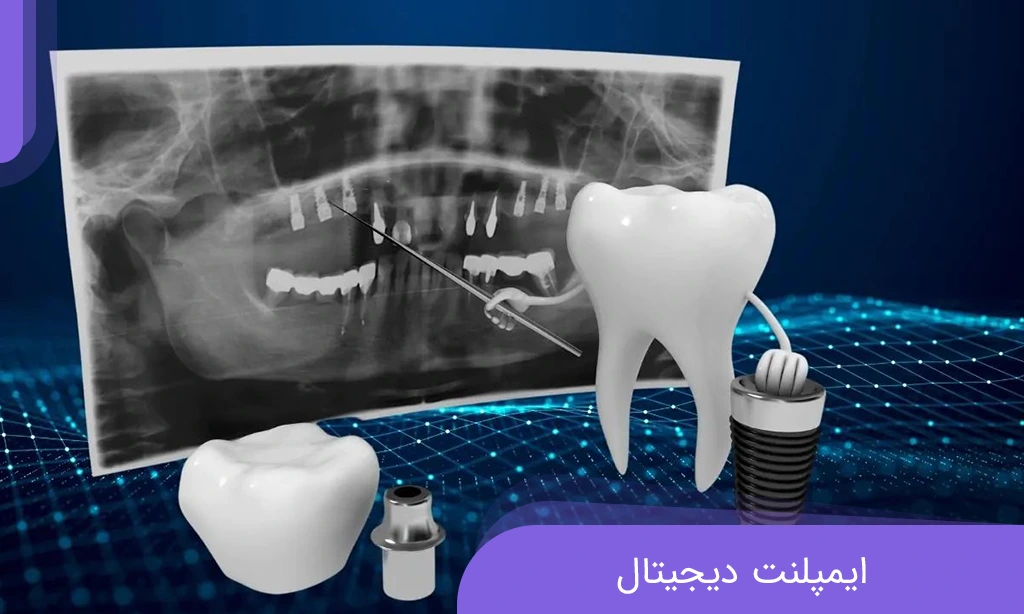 ایمپلنت دیجیتال چیست؟ طول عمر و عوارض ایمپلنت دندان دیجیتال | دکتر خادوی