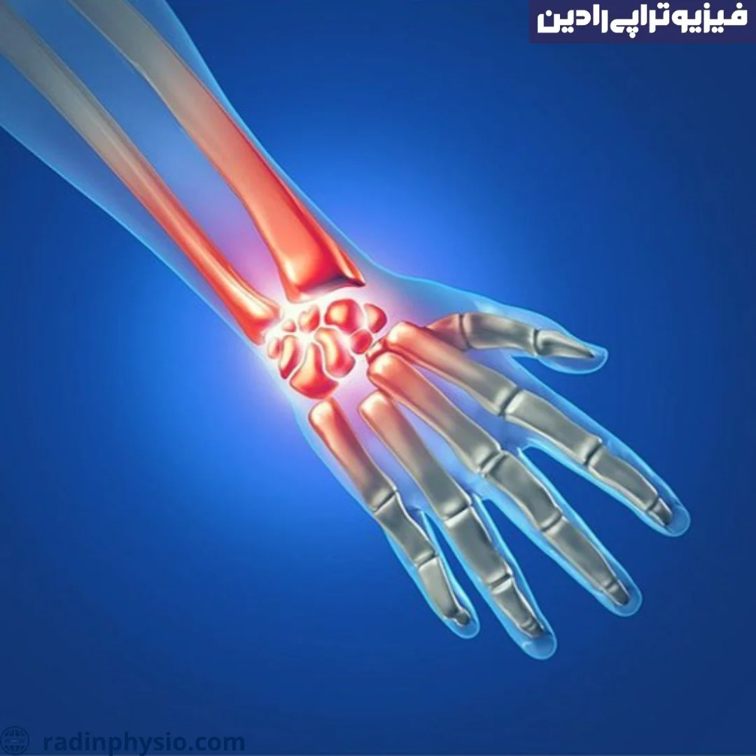 فیزیوتراپی تنوسینوویت چرکی (عفونت غلاف تاندون دست) - کلینیک فیزیوتراپی رادین