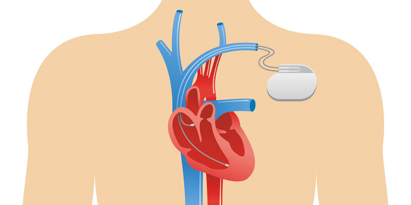 What is a heart pacemaker and how does it work? Dr. Hekmat Clinic