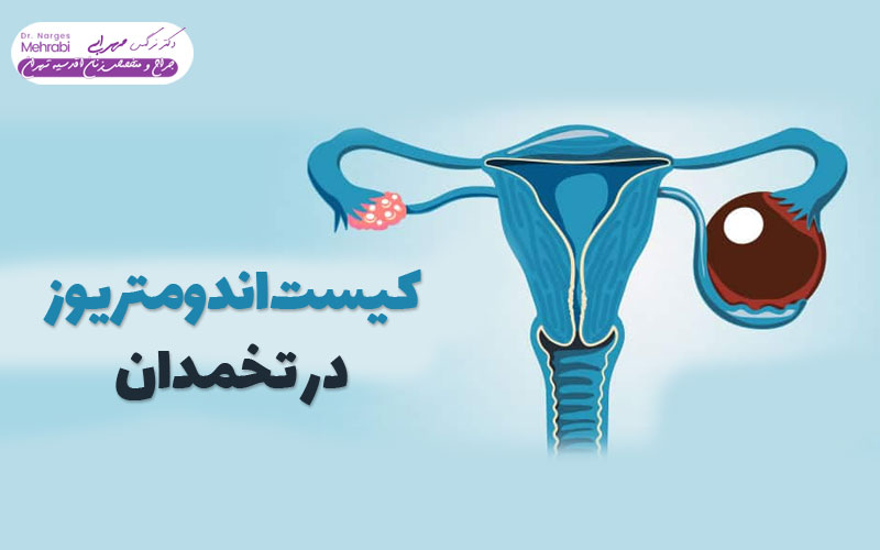 کیست اندومتریوز در تخمدان دکتر نرگس محرابی