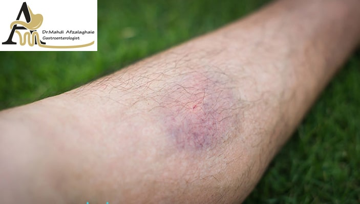 Embolism after gastric sleeve operation - gastroenterologist in Mashhad Dr. Mehdi Afzal Aghaei