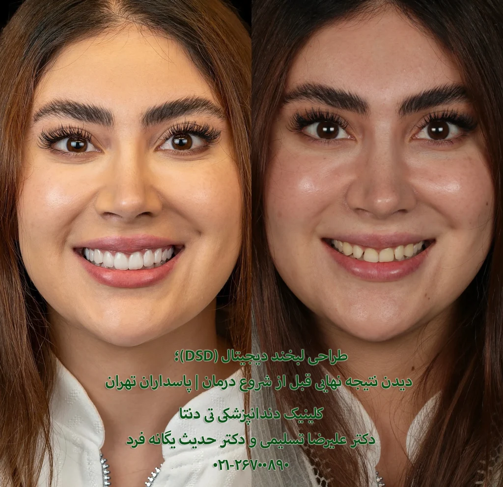 طراحی لبخند دیجیتال در تهران پاسداران 1404| تست طراحی لبخند + هزینه