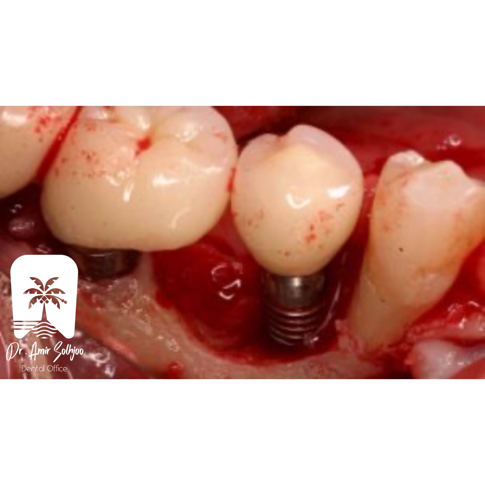 ایمپلنت ایرانی بررسی انواع و بهترین نوع ایمپلنت