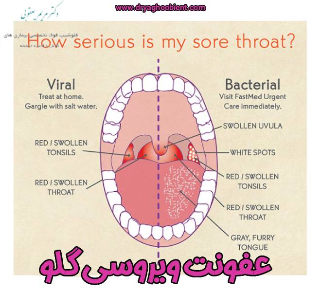 What is a viral throat infection? | The difference between viral and bacterial throat infection