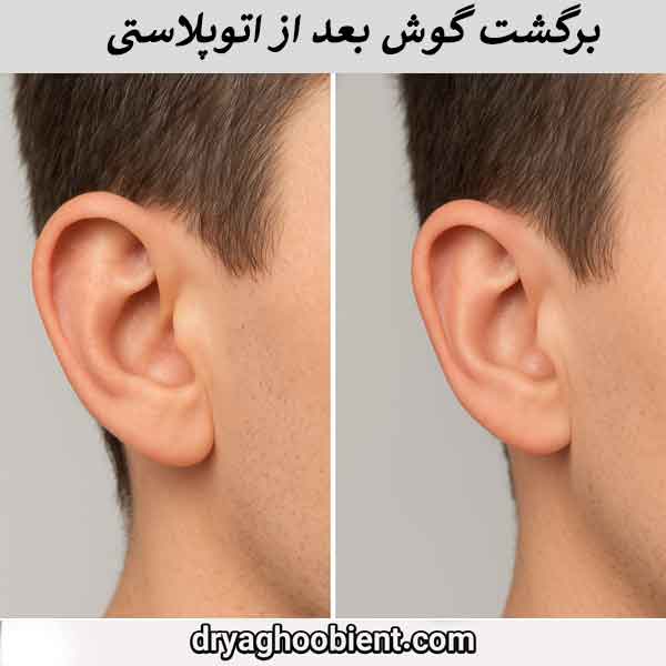 Successful and long-lasting otoplasty: prevention of ear recurrence after surgery