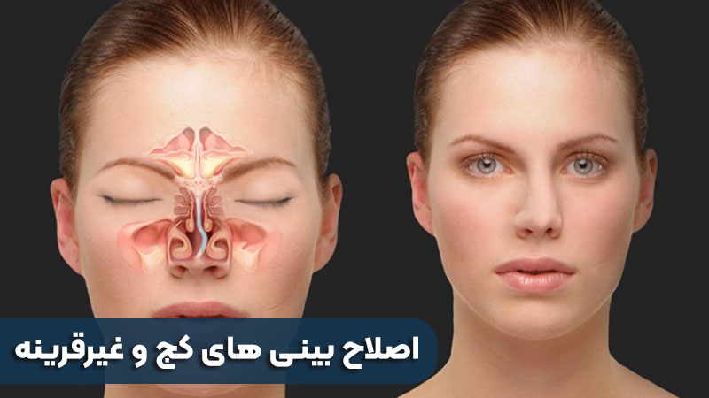 طرق علاج الأنف الملتوي وغير المتماثل