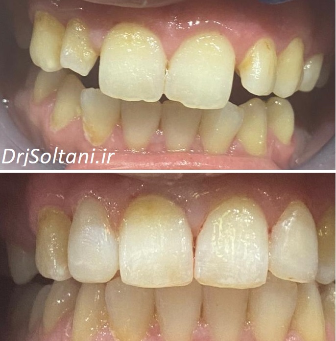 لمینت دندان های قدامی بالا دکتر جمال سلطانی جراح دندانپزشک و متخصص ایمپلنت در تبریز