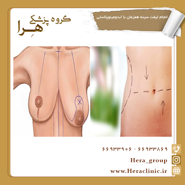 Is breast lift performed at the same time as abdominoplasty?