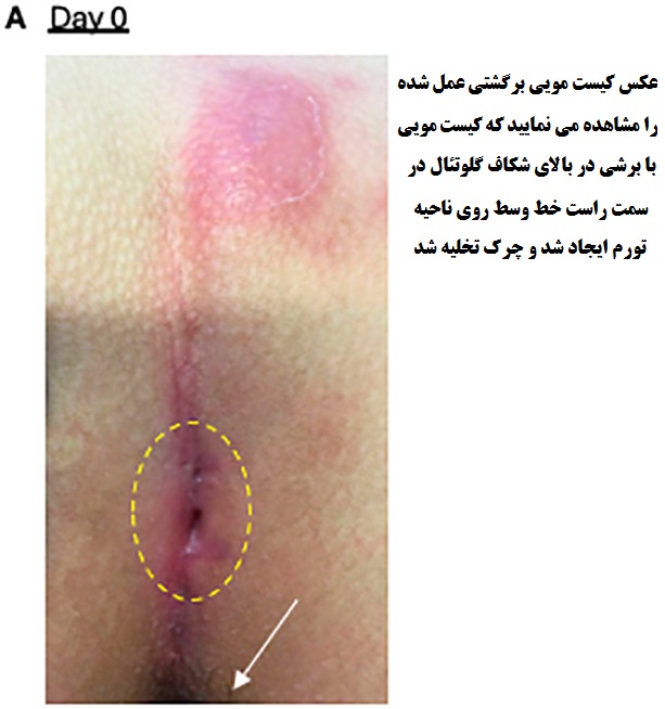 عکس کیست مویی در مراحل اولیه