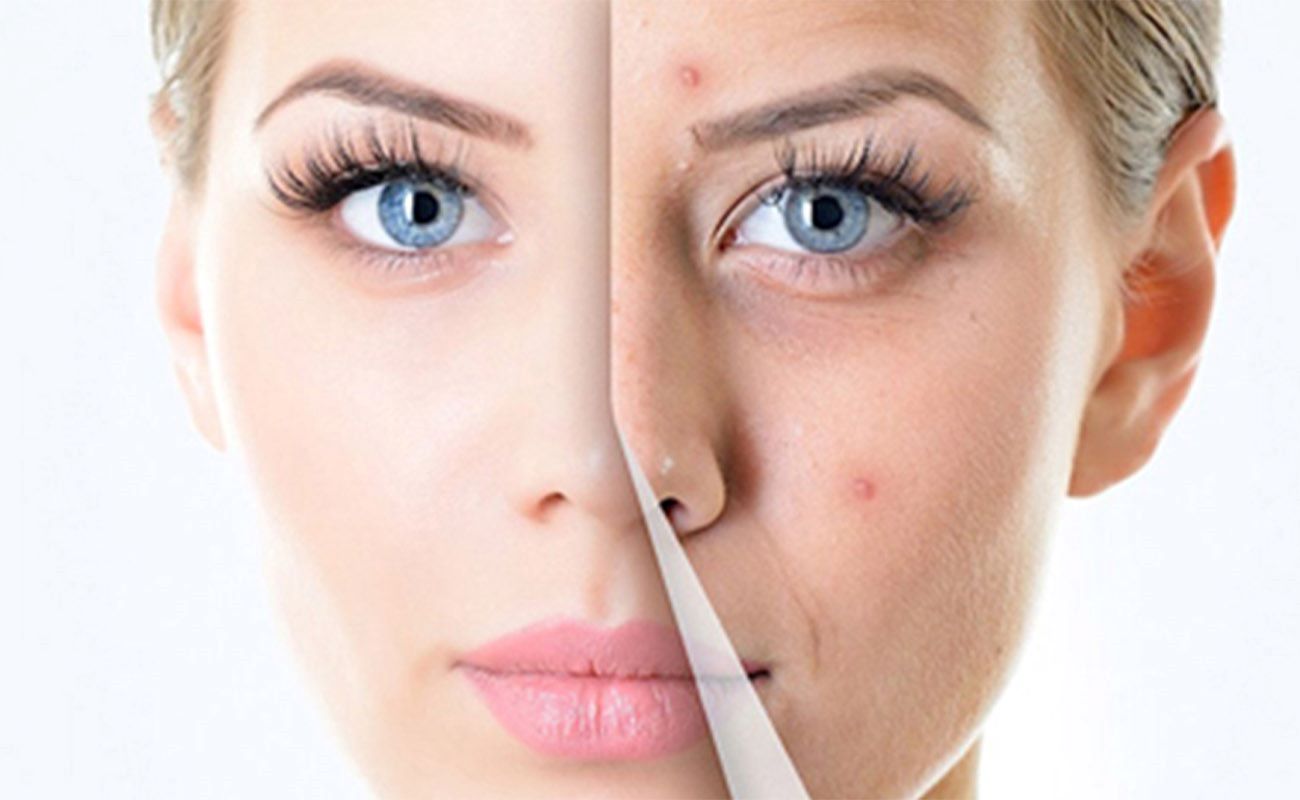 Microneedling center in Zafar