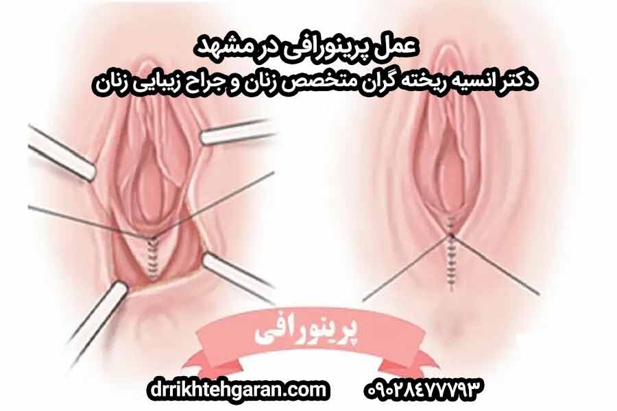 عملية ما قبل الحيض في مشهد؛ ترميم العضلات وتجميل العجان بتقنيات متقدمة للدكتورة أنيسة روزغاران