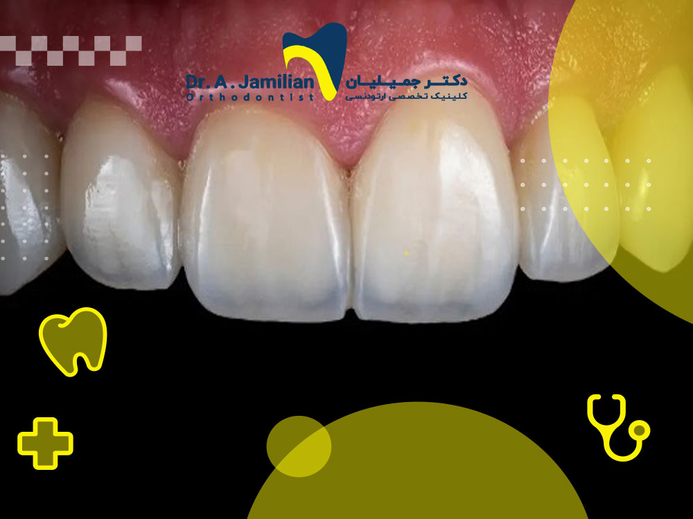 The cause of front teeth thinning and methods of prevention and treatment - Dr. Jamilian