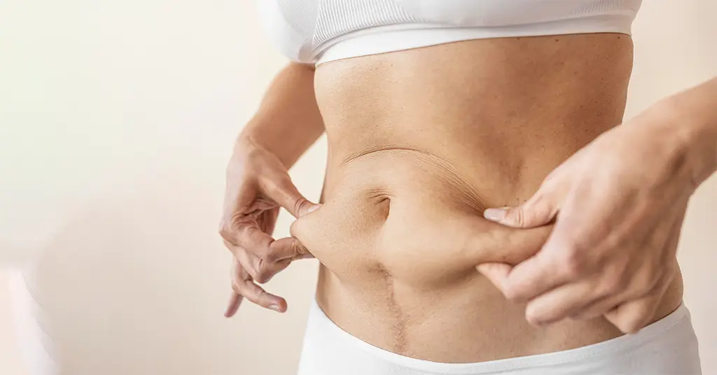 Abdominal fat removal