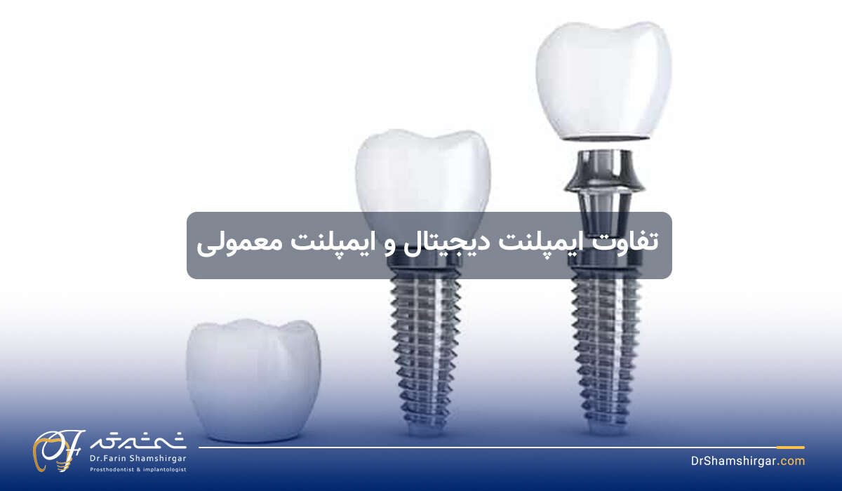 تفاوت بین ایمپلنت دیجیتال و ایمپلنت معمولی چیست؟