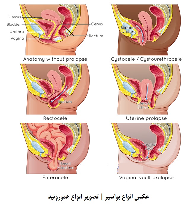 عکس هموروئید عکس بواسیر خفیف عکس هموروئید خارجی
