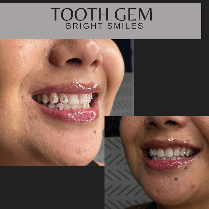 کاشت دندان نگینی در اصفهان با دکتر دیباجی پور + لیست قیمت