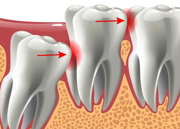 Wisdom teeth should be pulled or not