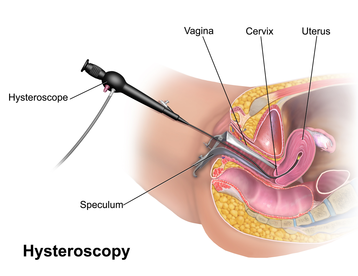 Hysteroscopy - Hera Medical Group