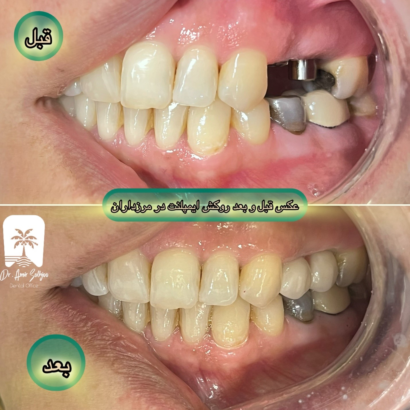 بهترین پزشک ایمپلنت در غرب تهران: راهنمای انتخاب متخصص