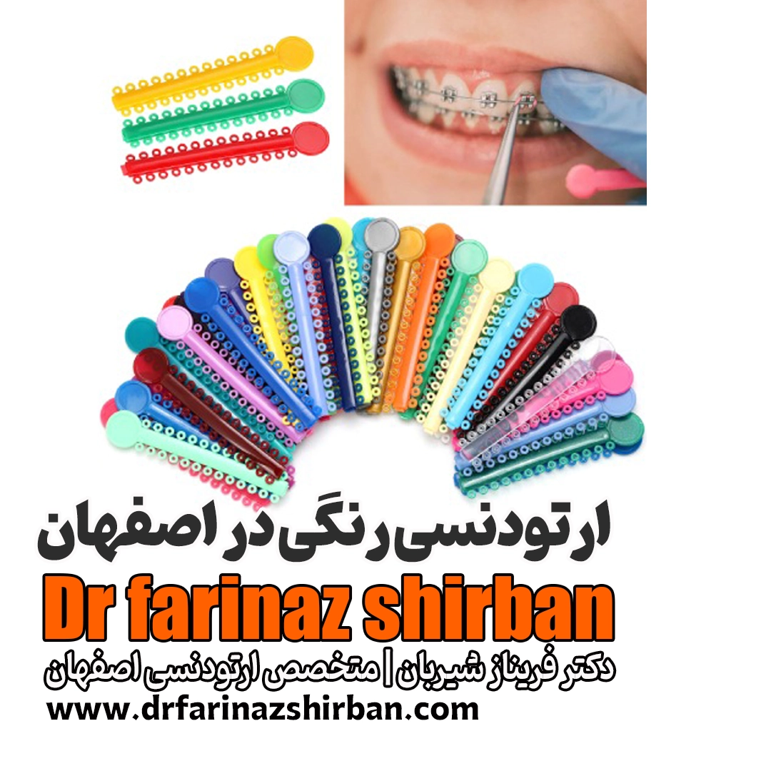 ارتودنسی رنگی در اصفهان انتخاب رنگ مورد نظر برای لبخندی جذاب