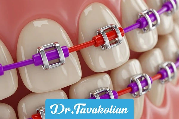 الأقواس الملونة لأسنان الأطفال - دكتور توكليان