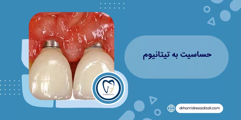 آلرژی به تیتانیوم - علائم و درمان آن دکتر حمیدرضا افضلی