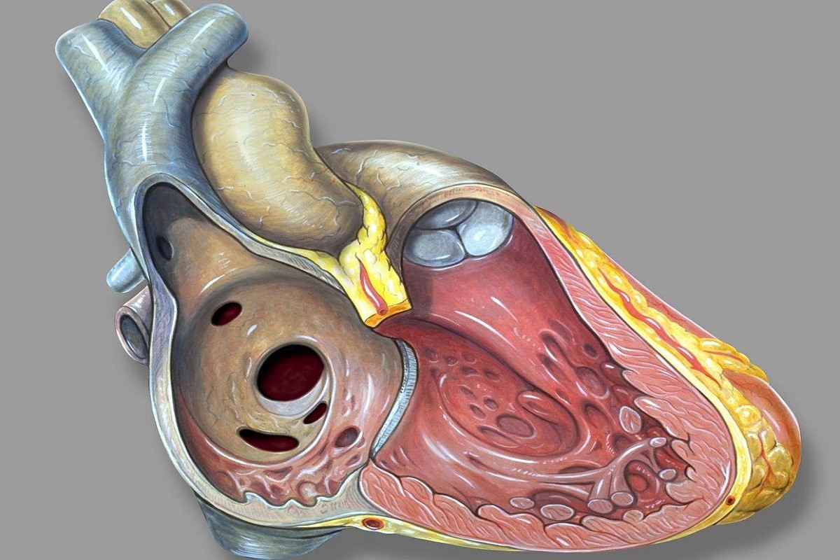 عوارض بعد از عمل سوراخ کردن قلب - دکتر نجفی