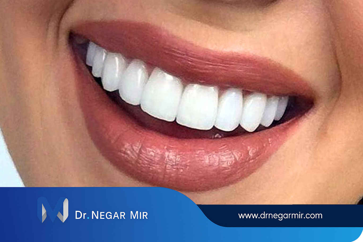 قشرة حافة شفافة مركبة في عيادة الدكتور نيجار مير 1404